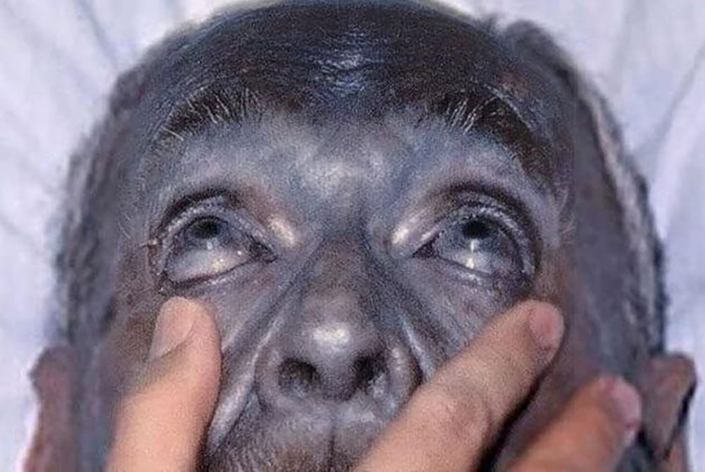 The Genetic Condition - Methemoglobinemia